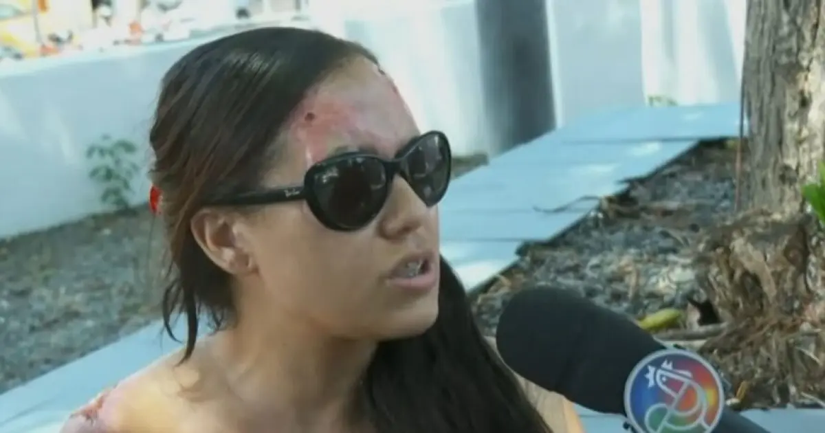 Atacada com ácido por companheira de ex-marido, mulher busca justiça